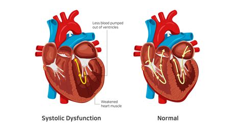 what is lv systolic dysfunction